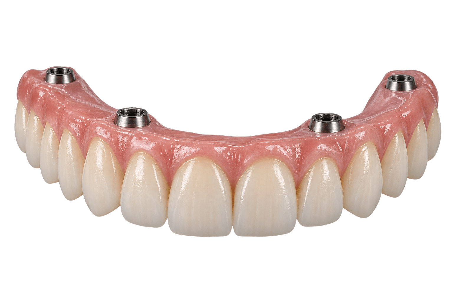 All-on-Four full-arch implant restoration