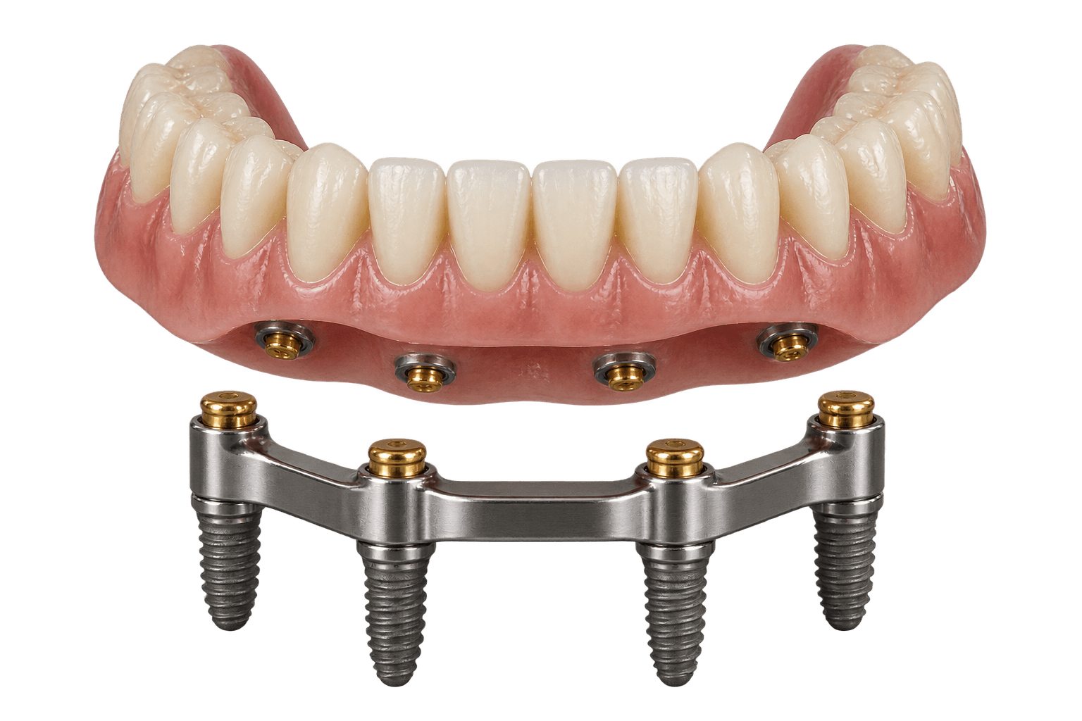 Implant-supported Locator bar overdenture