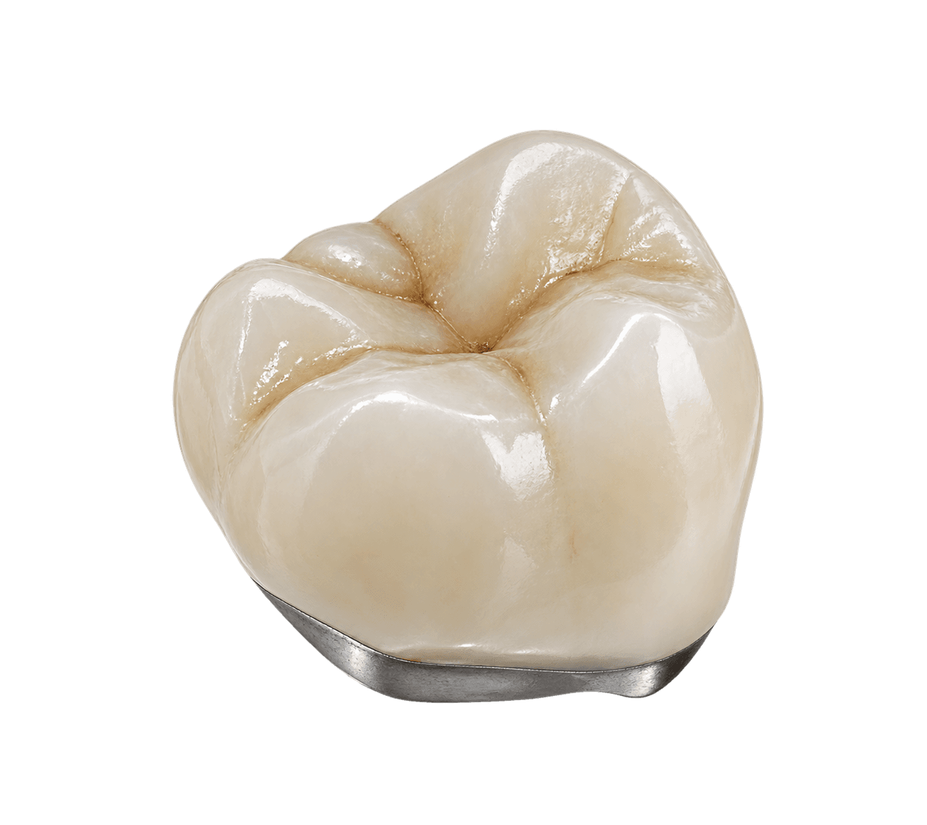 Porcelain-fused-to-metal PFM restoration
