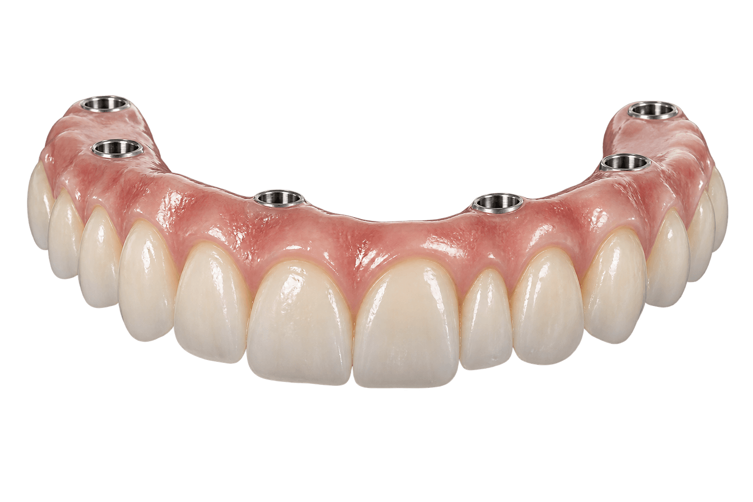 Screw-retained implant hybrid prosthesis