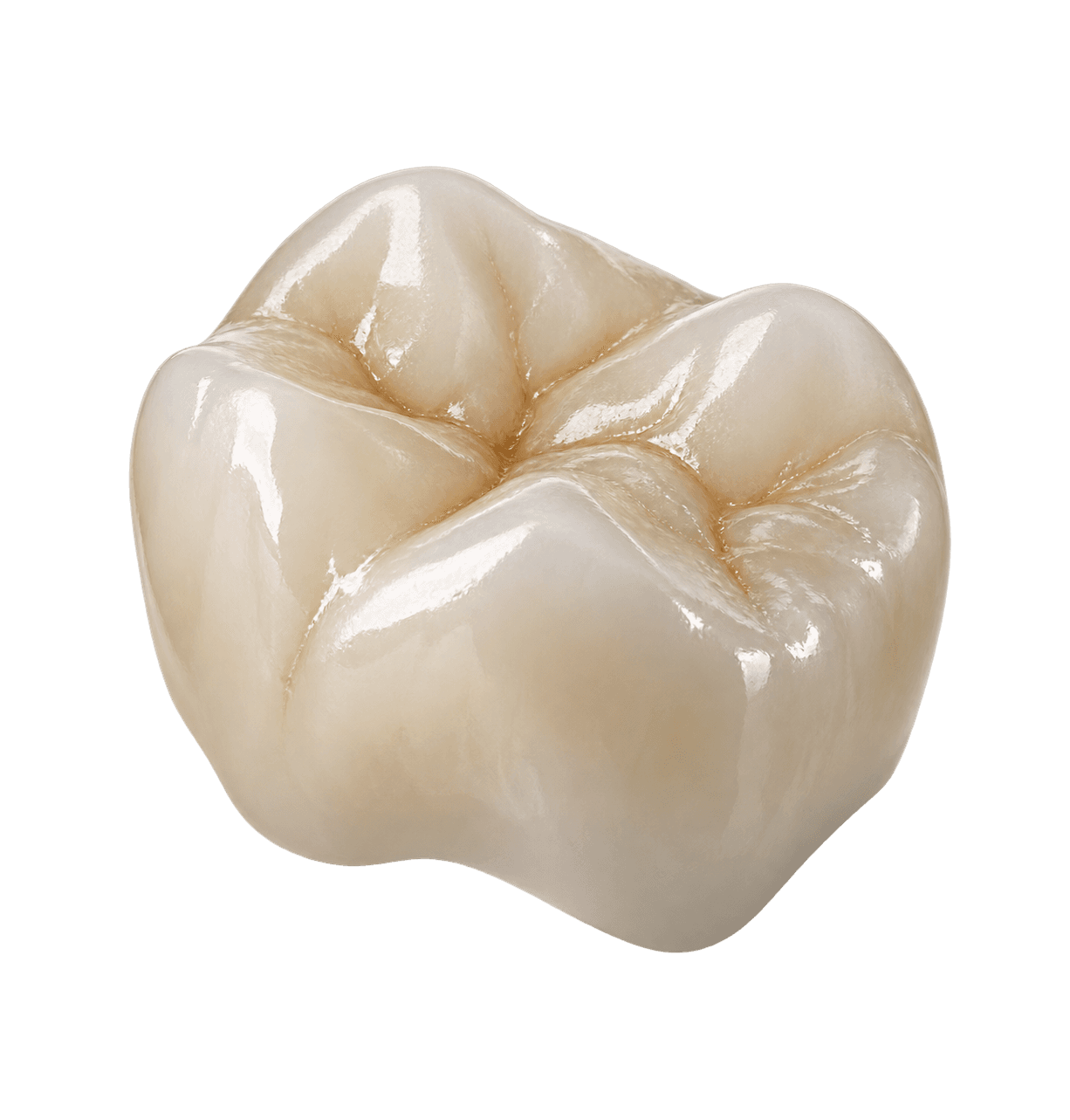 Porcelain-fused-to-zirconia PFZ restoration